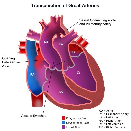 Image of congenitalheartdisease-diagram-heartarteriestransposition.jpg