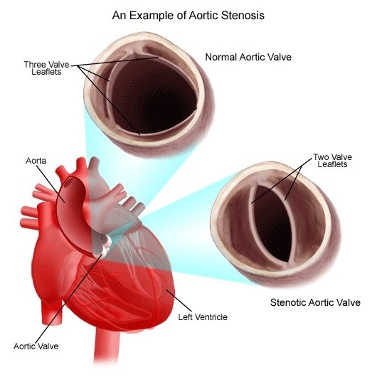 Image of congenitalheartdisease-diagram-heartaorticstenosis.jpg