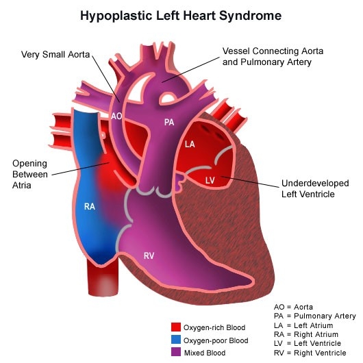 Image of congenitalheartdisease-diagram-hearthypoplastic.jpg