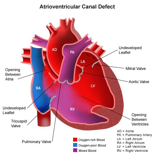 Image of congenitalheartdisease-diagram-heartcanaldefect.jpg