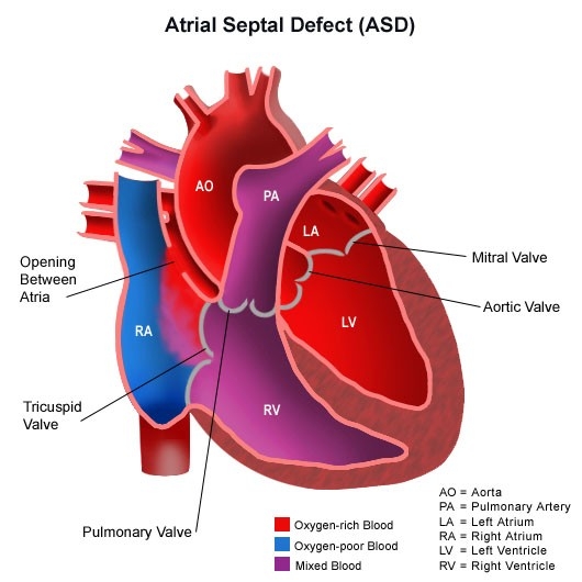 Image of congenitalheartdisease-diagram-heartatrialseptaldefect.jpg