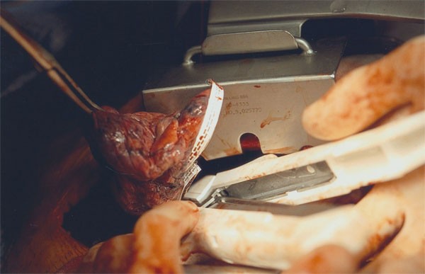 Intraoperative photo showing the stapling device used to remove the most abnormal, emphysematous lung tissue