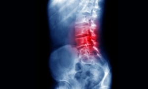 Reduced Risk of Lumbar Disc Reherniation with Annular Closure Device